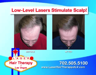 Las Vegas Laser Hair Restoration Service