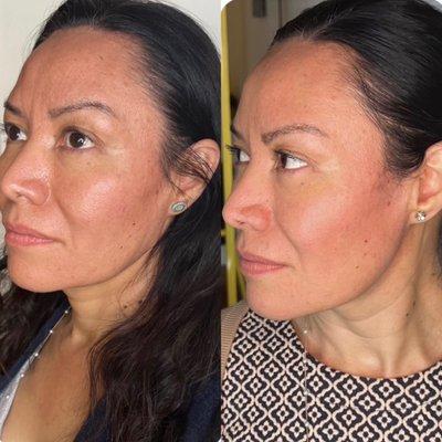 Facial Contouring (Botox, Under Eye Filler, Collagen Filler)