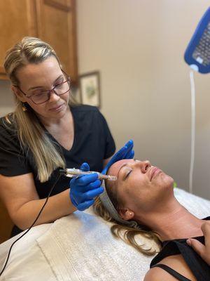 Microneedling Treatment