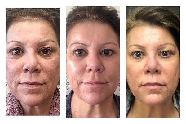 Non surgical Facelift