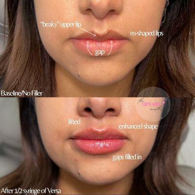 M-shaped lip correction using Revanesse Versa filler.