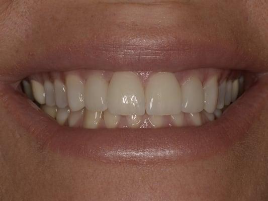 Porcelain veneers.