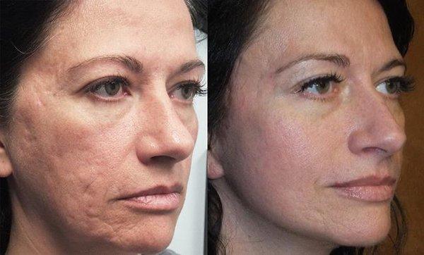 Microneedling