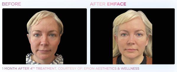 Emface is a non invasive nonsurgical procedure to help lift your face muscles, this procedure helps with jowls, skin laxity and facial aging