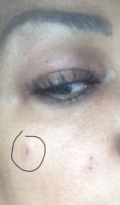 Where the dr burnt off my beauty mark.