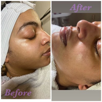 Dermaplane facial