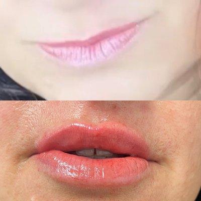 Before & after !! She had no top lip! Now they match!!