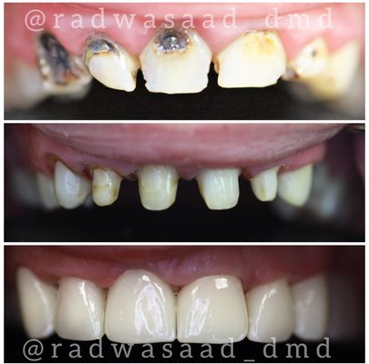 Porcelain crowns and root canal treatment to restore the smile and function. The patient can smile now with confidence.