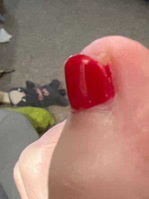 Ingrown toenail left by the salon worker