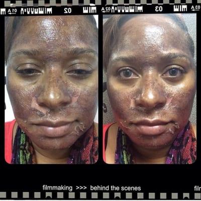 Chemical peel