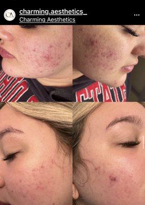 One acne treatment 
Two week difference