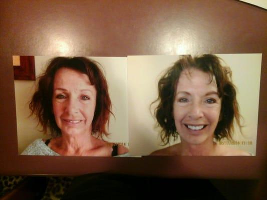 Before and after full smile  photo. DrClayRobertMiller not only repairs back injuries, but also the face !