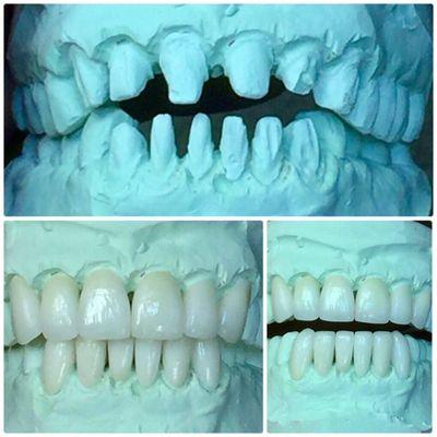 E-Max Anterior Crowns.