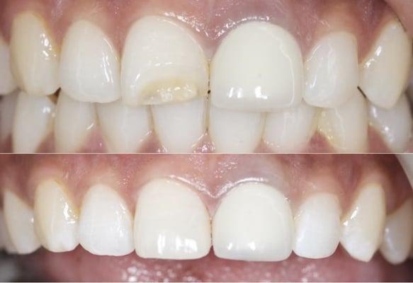 Treatment of an emergency fractured tooth with composite