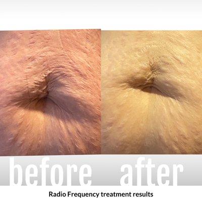 Stretch mark and RF treatments