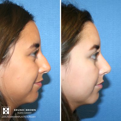 Rhinoplasty