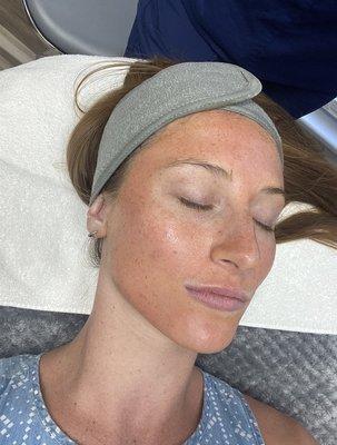 The Perfect Derma Peel chemical peel