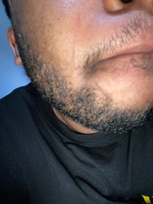 Scars on beard line and face