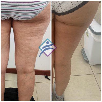 Cellulite Reduction
Reducción de celulitis