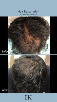 Click to learn more about this procedure: https://www.drkhorasani.com/cosmetic-dermatology/non-invasive/hair-restoration