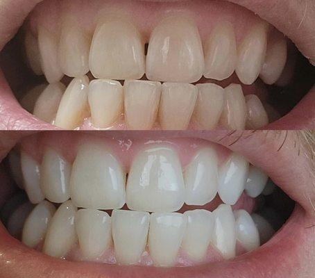 Do you smoke!? Are you a coffee drinker? I can help you with those stains and create an amazing smile!