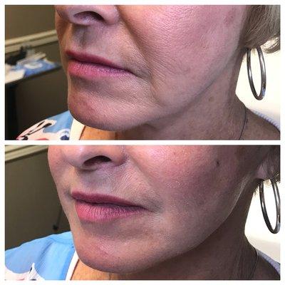 Nonsurgical facelift with PDO threads