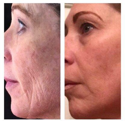 Before & After photo of our New Cutting Edge Stem Cell Regenerative Facial