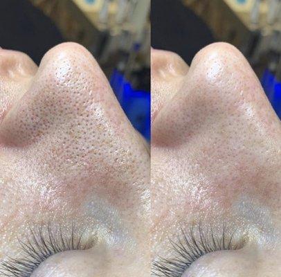 Before and after our Signature Hydrafacial