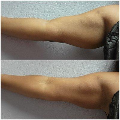 Before and After: One Session of Non-invasive Laser Lipo to Arms.