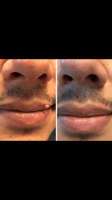 before & after skin tag removal on lip