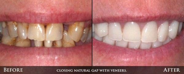 Before and After Denture