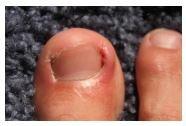 We treat ingrown toenails