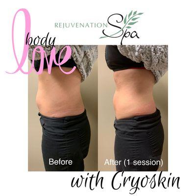 Slim, Lift & Tone the body you want with Cryoskin! No suction, no pain, & no downtime. #lessfatmoreyou #nofilter