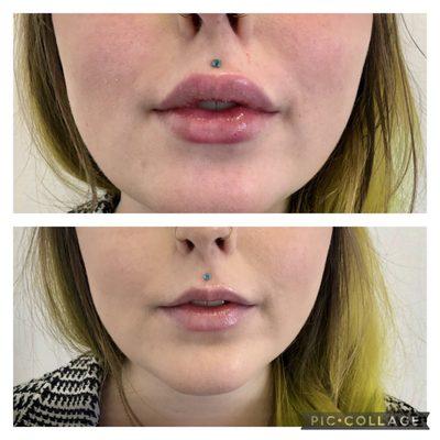 Before and after lip filler