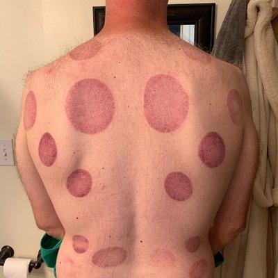 Some cupping marks. Looks painful, but helps a great deal with alleviating pain.