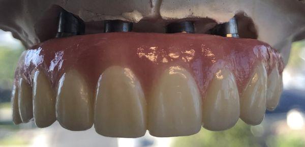 Fixed zirconia full upper for implants