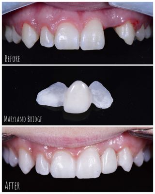 Dental bridge to replace one tooth