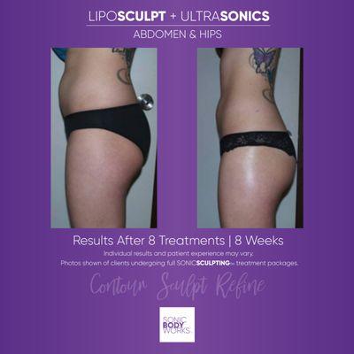 Non-Invasive Targeted Fat Loss treatments for stubborn fat. Lose an Inches in 1 hour with no downtime or recovery.