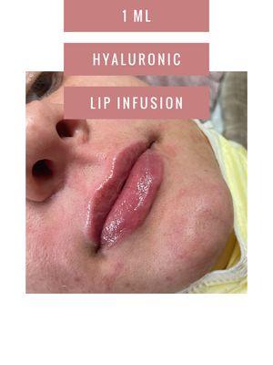 HYALURONIC LIP INFUSION