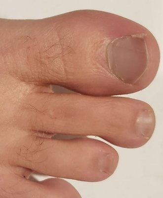 Toe nail after laser