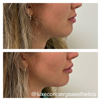 Natural looking lip and chin enhancement using dermal fillers