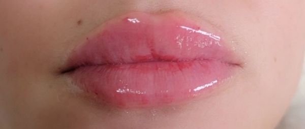 Get your plump lips at The Golden Wink Spa!