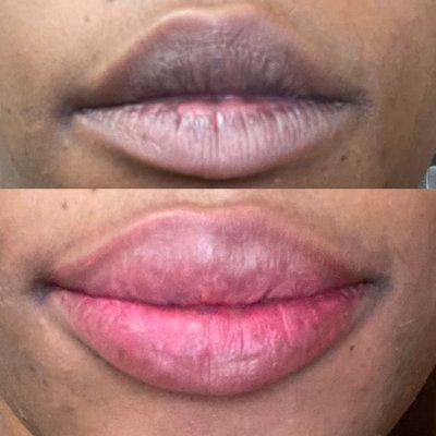 Full lip correction and line to minimize dark line. After session