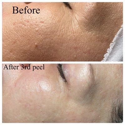 Amazing results just after 3rd treatment of CASMARA Chemical Peel