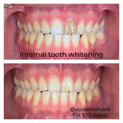 Internal tooth whitening aT VIP Dental Care 718 575-0060