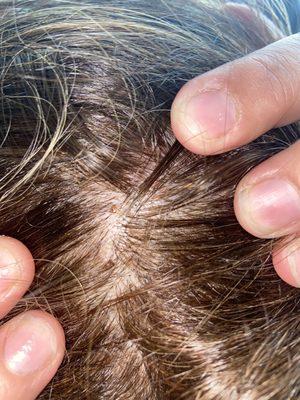 Burns in scalp .