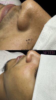 Before and after! Healthier skin & clean pores