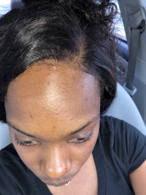 Pleas ladies don't come to this salon! 4 days after getting my first closure I noticed this. She basically told me this was normal.