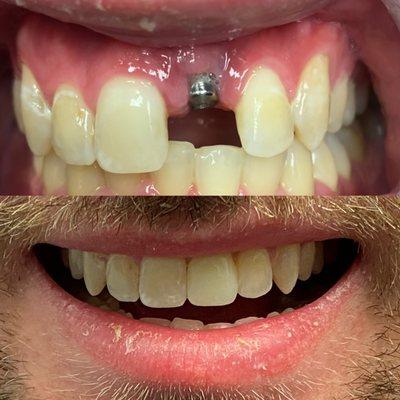 Single implant placement and crown