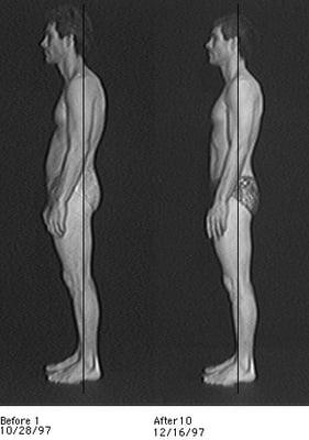 Before and after Rolfing pictures